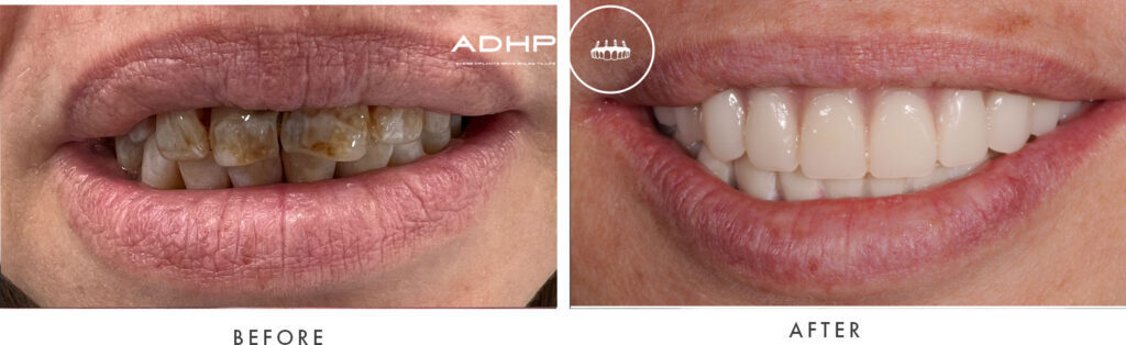 Before and after photographs of an ADHP smile restoration patient