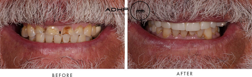Before and after photographs of an ADHP full-arch implant patient