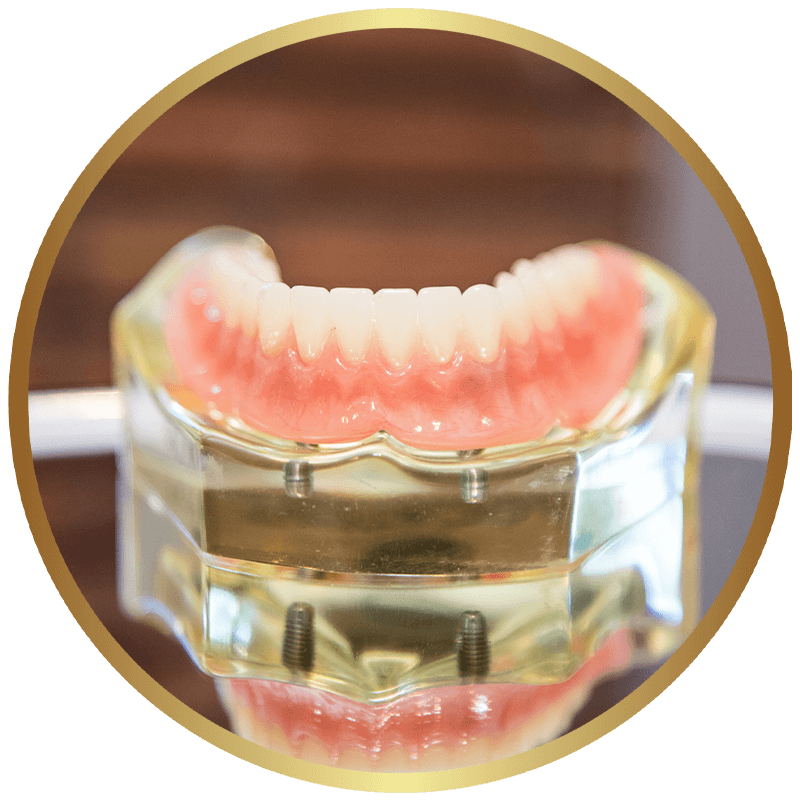 Three-dimensional rendering of a full-arch implant restoration