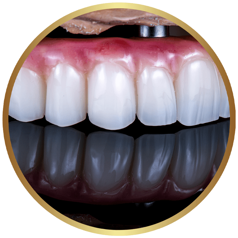 Rendering of a full mouth dental implant restoration