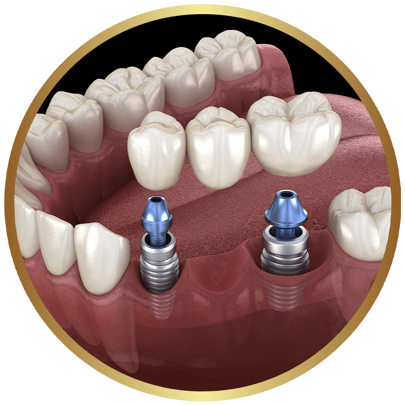 Three-dimensional rendering of an implant-supported bridge