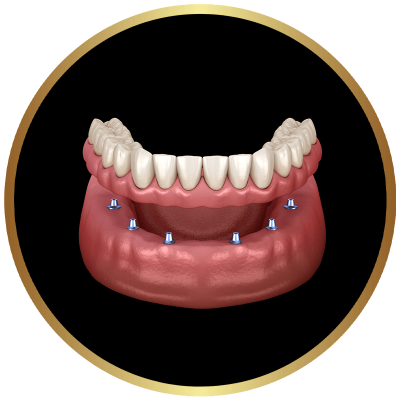 Rendering of an implant-supported denture