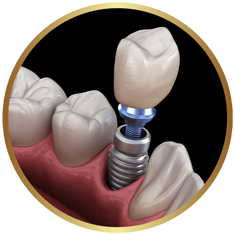 Rendering of a single dental implant