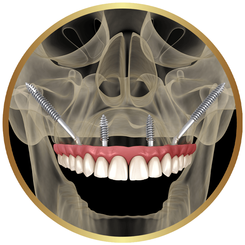 Three-dimensional rendering of a zygomatic implant anchored in the cheekbone