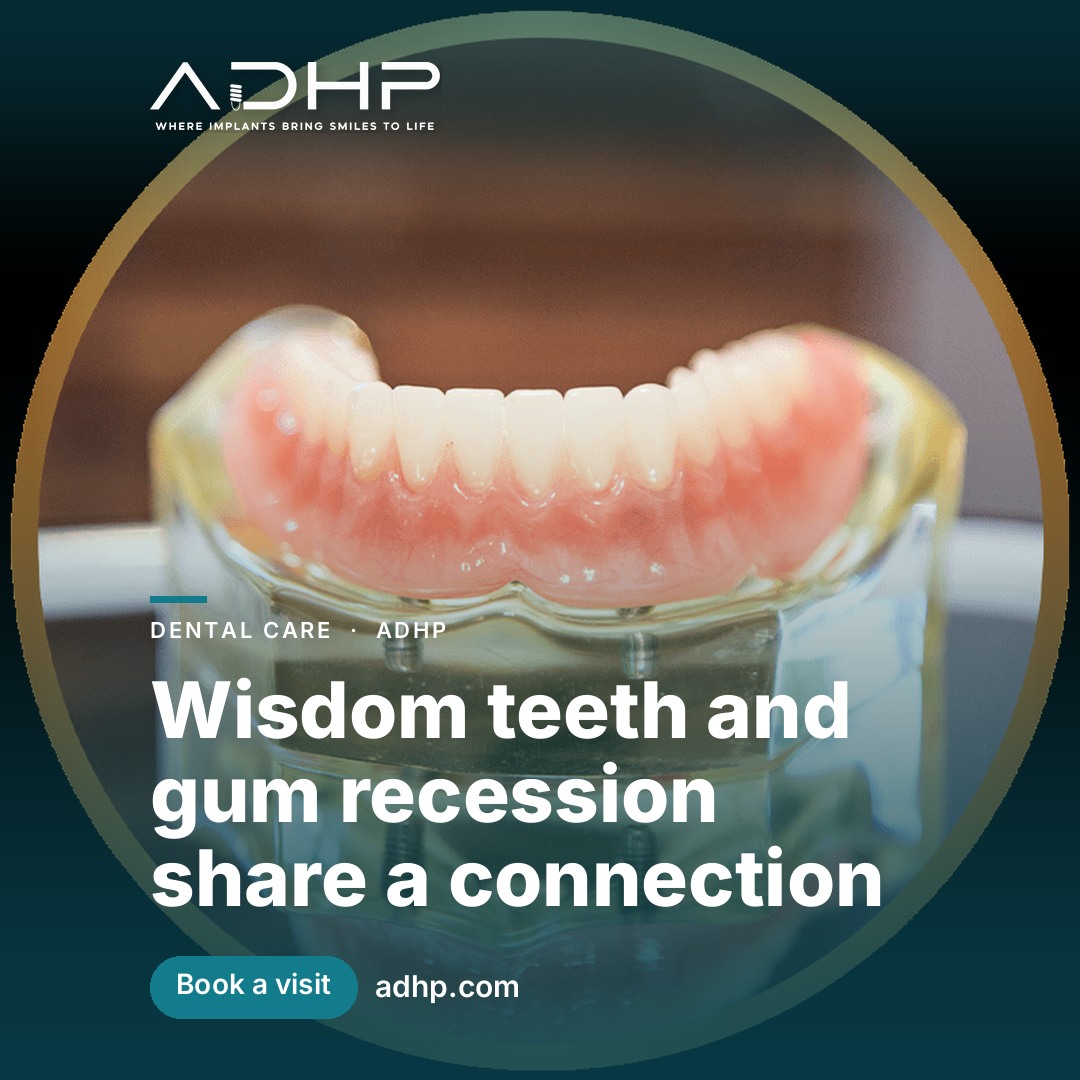 Wisdom teeth and gum recession share a connection