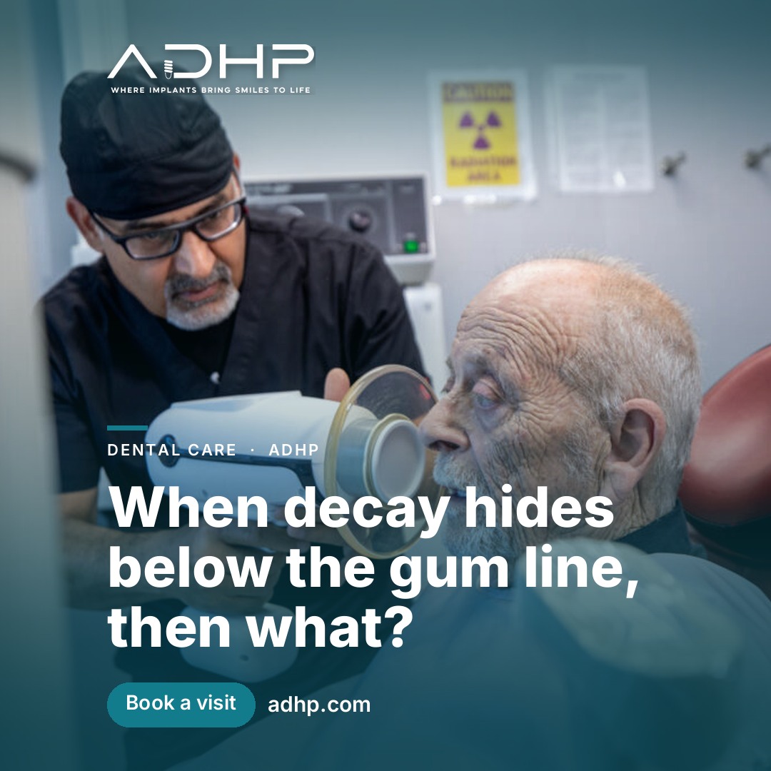 When decay hides below the gum line, then what?