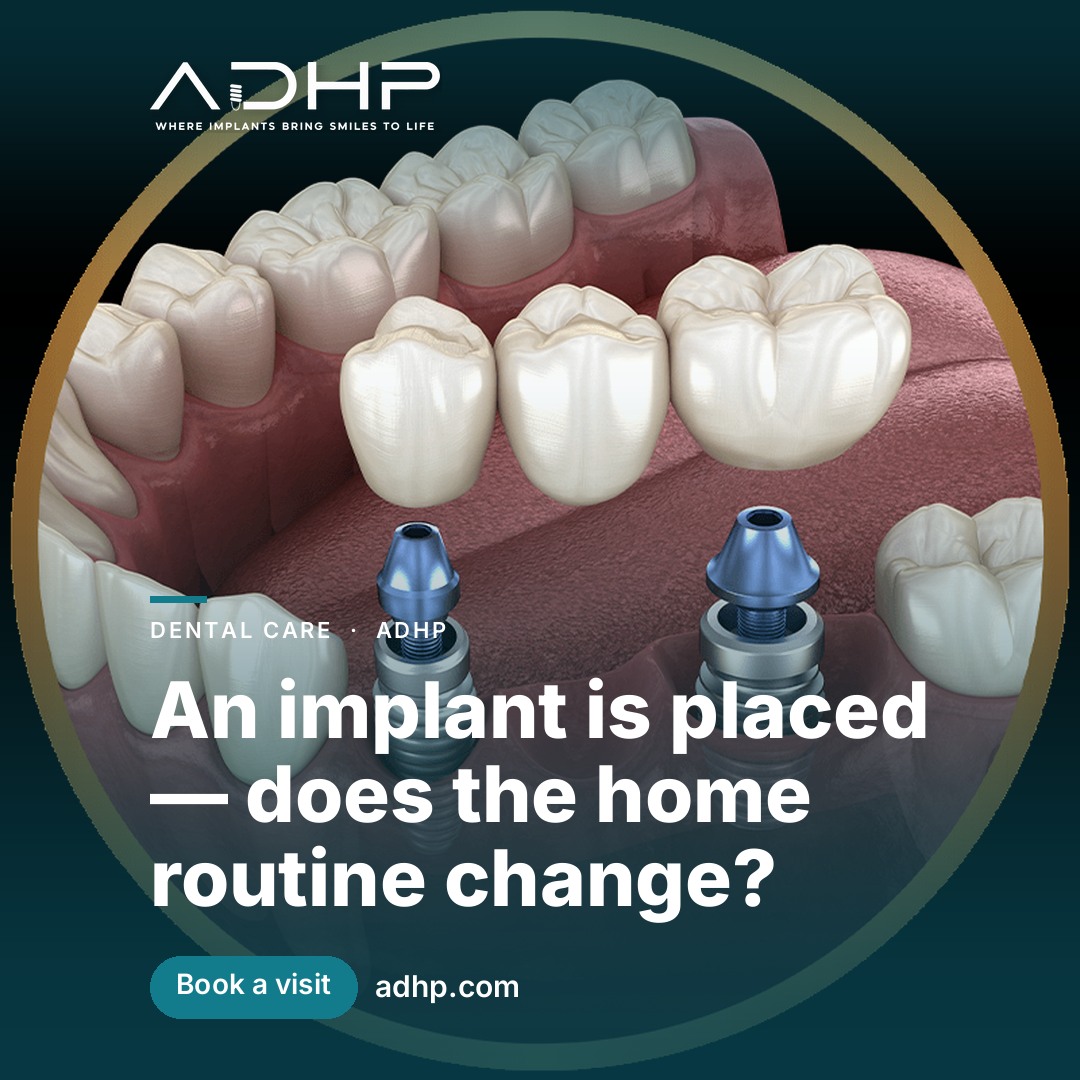 An implant is placed — does the home routine change?
