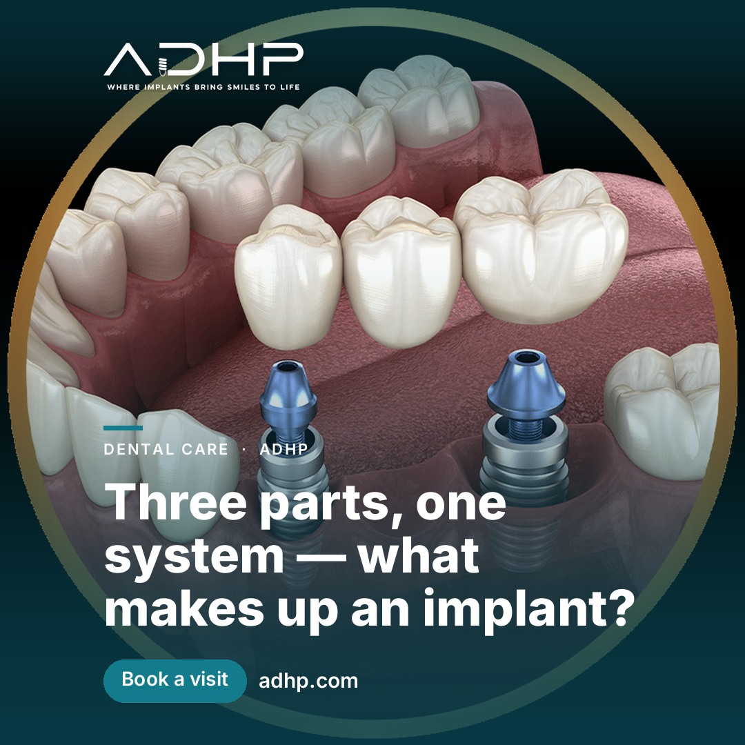 Three parts, one system — what makes up an implant?