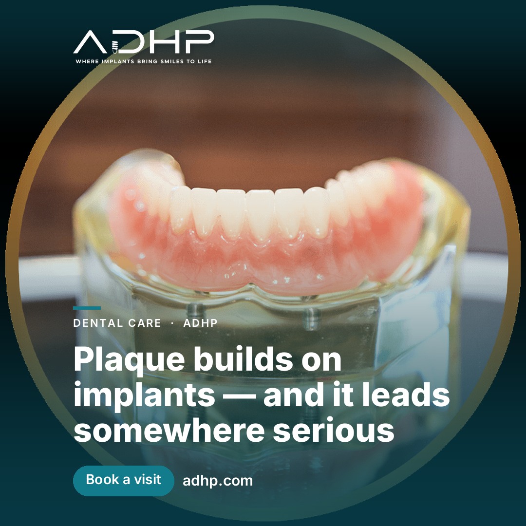 Plaque builds on implants — and it leads somewhere serious